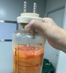 涉县水动力吸脂手术要做多久？